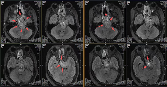 十年与“百万分之一”的较量:河北一洲肿瘤医院一位25岁脊索瘤患者的重生之路 十年与“百万分之一”的较量:河北一洲肿瘤医院一位25岁脊索瘤患者的重生之路